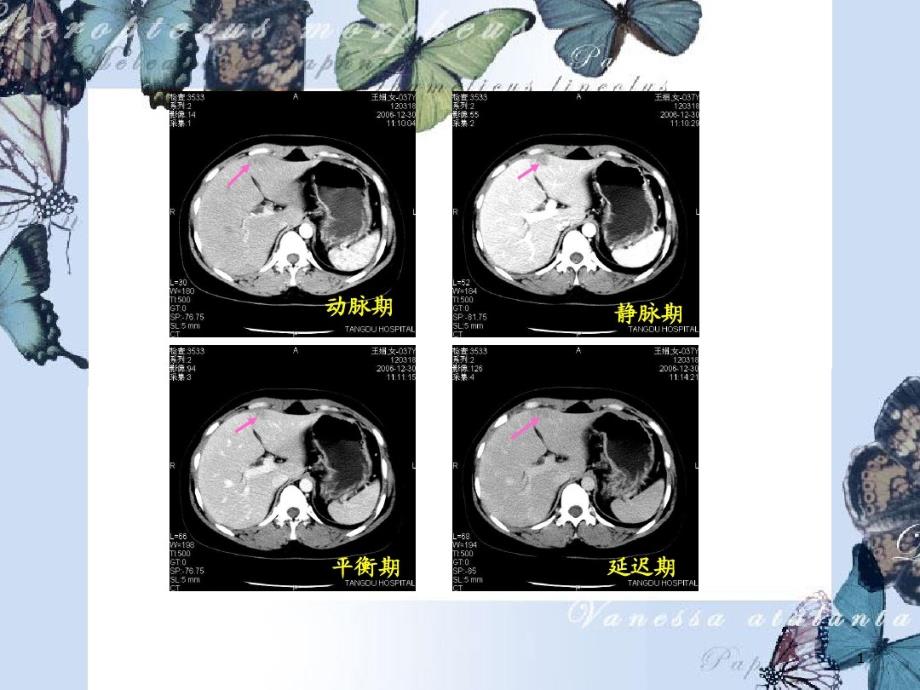 肝脏镰状韧带旁假课件_第1页