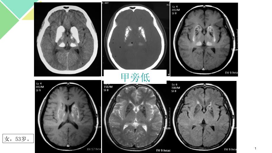 甲状旁腺功能减退症课件_第1页