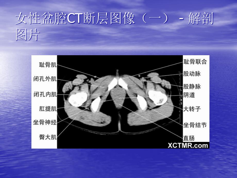 盆腔CT诊断培训教材课件_第1页