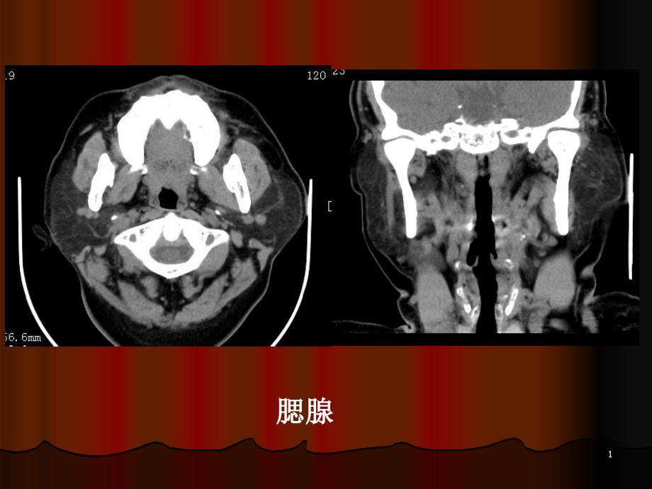 颌面部正常及异常的CT诊断课件_第1页