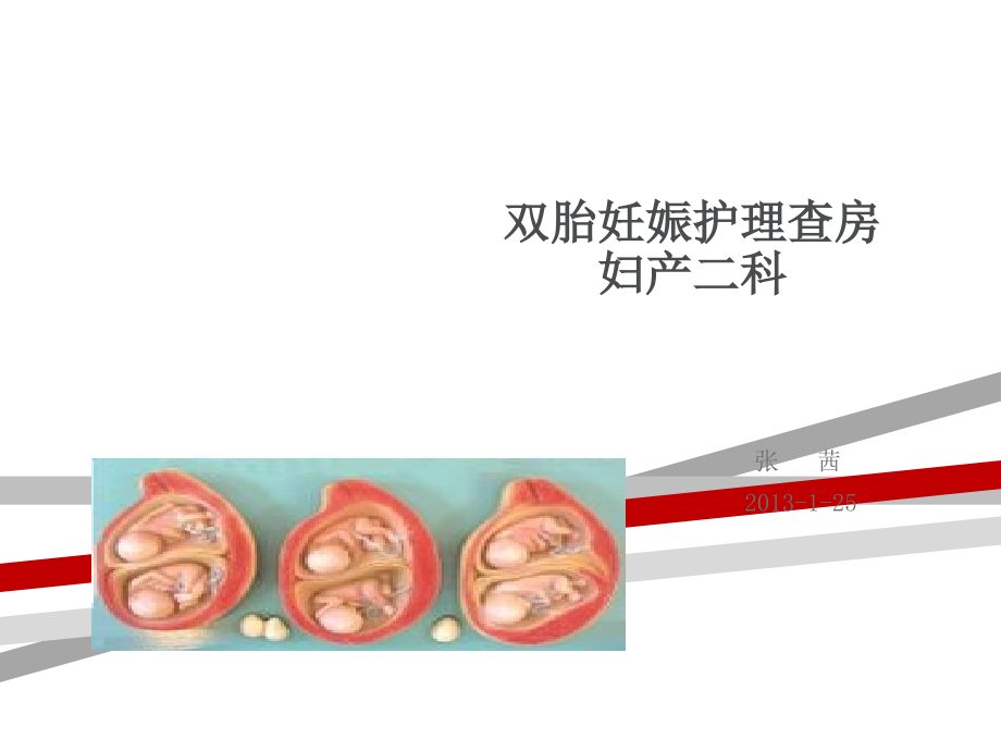 双胎妊娠护理查房课件_第1页