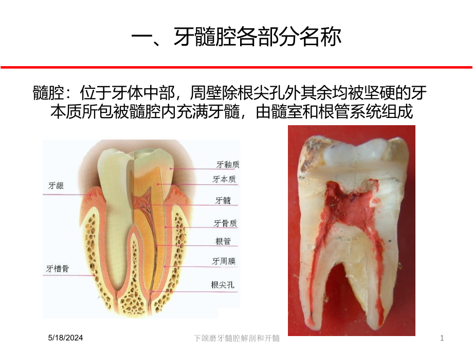 下颌磨牙髓腔解剖和开髓课件_第1页