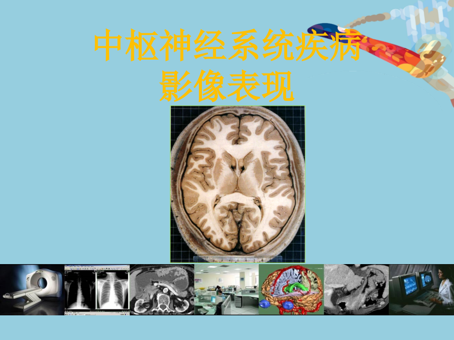 中枢神经系统疾病影像表现--课件_第1页