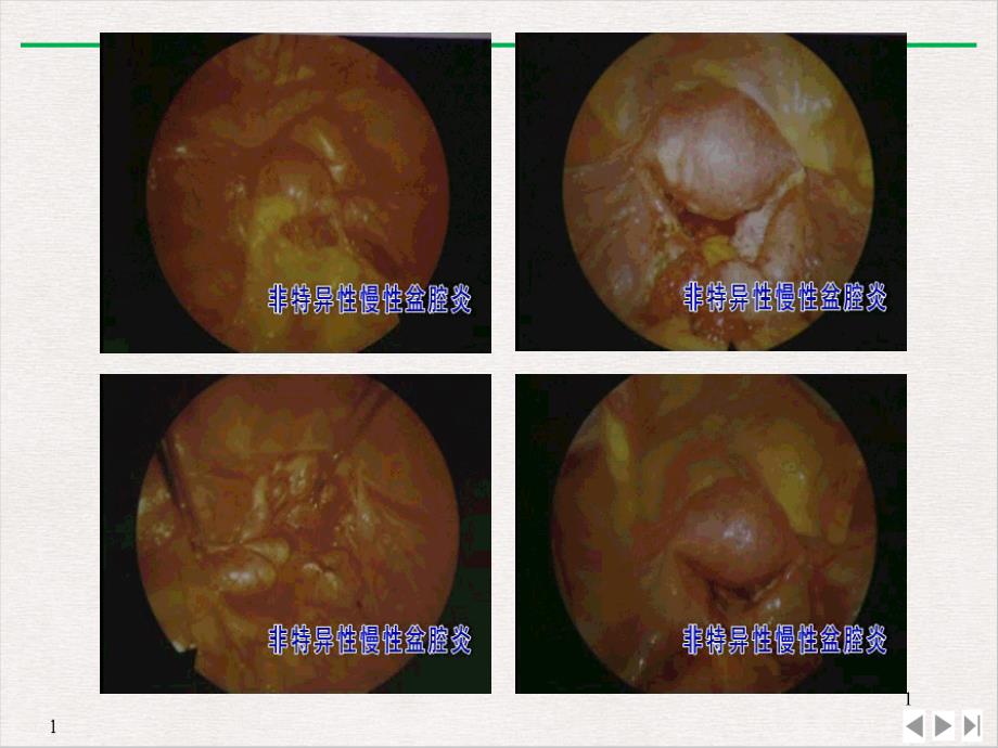 妇科疾病图片课件_第1页