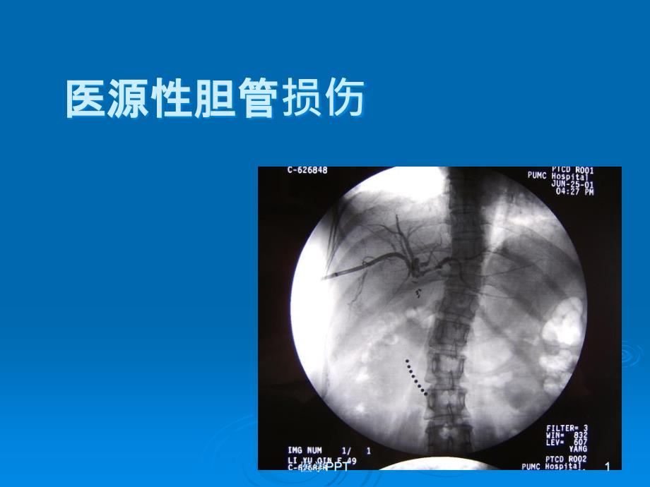 《医源性胆管损伤》课件_第1页