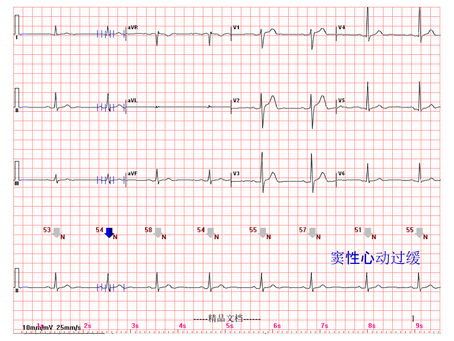 心电图常见正常和异常心电图图谱课件_第1页