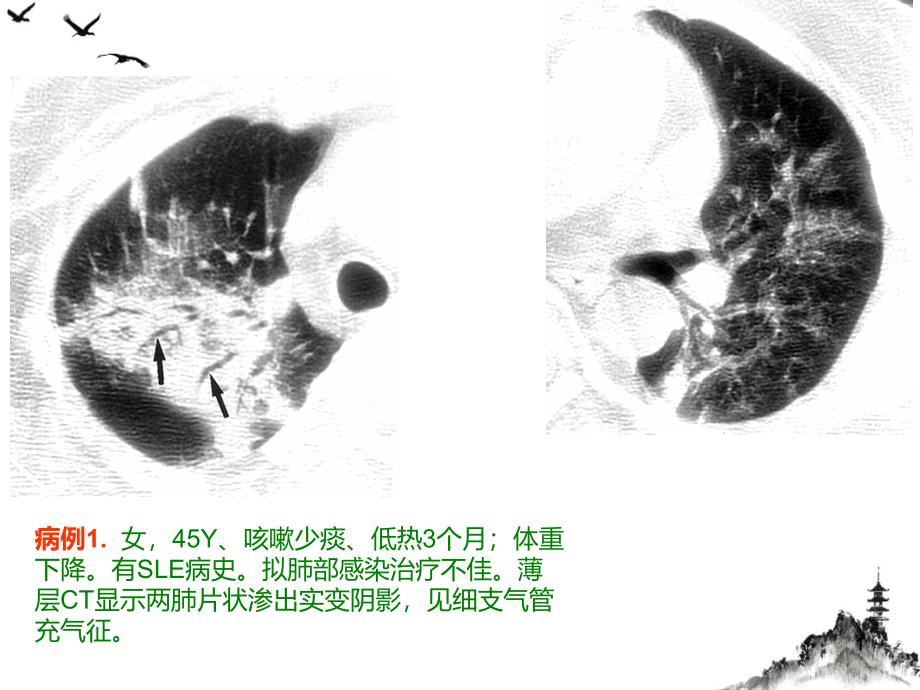 隐源性机化性肺炎的诊断进展ppt课件_第1页