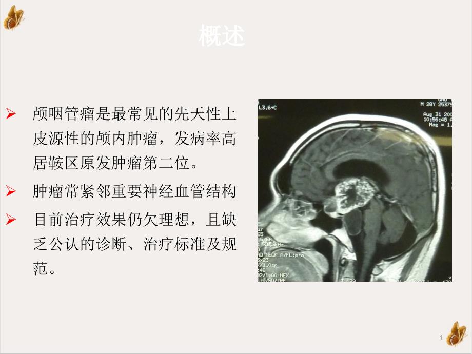 颅咽管瘤围手术期水电解质紊乱的处理原则课件_第1页