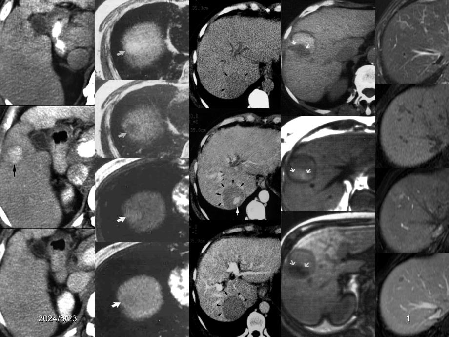 肝硬化结节的影像诊断课件_第1页