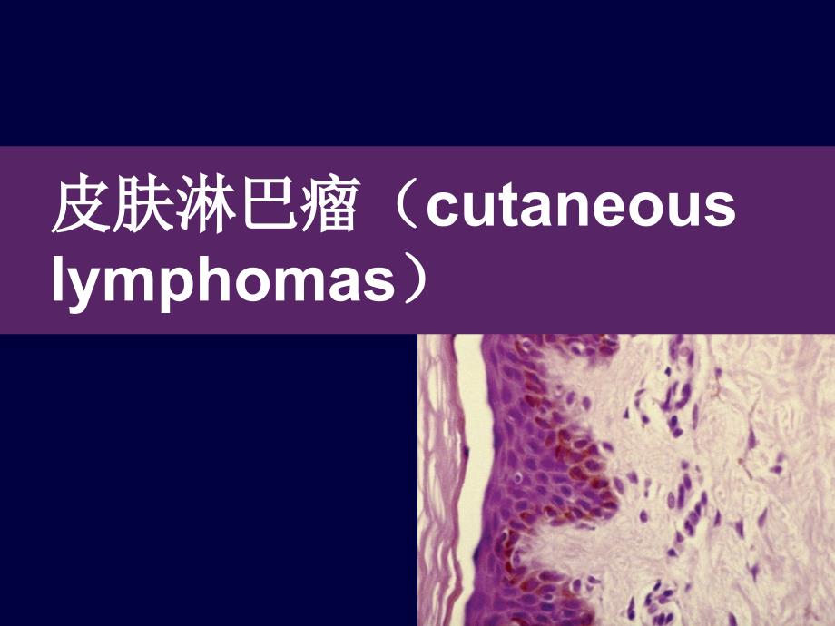 皮肤淋巴瘤诊断和治疗进展课件_第1页