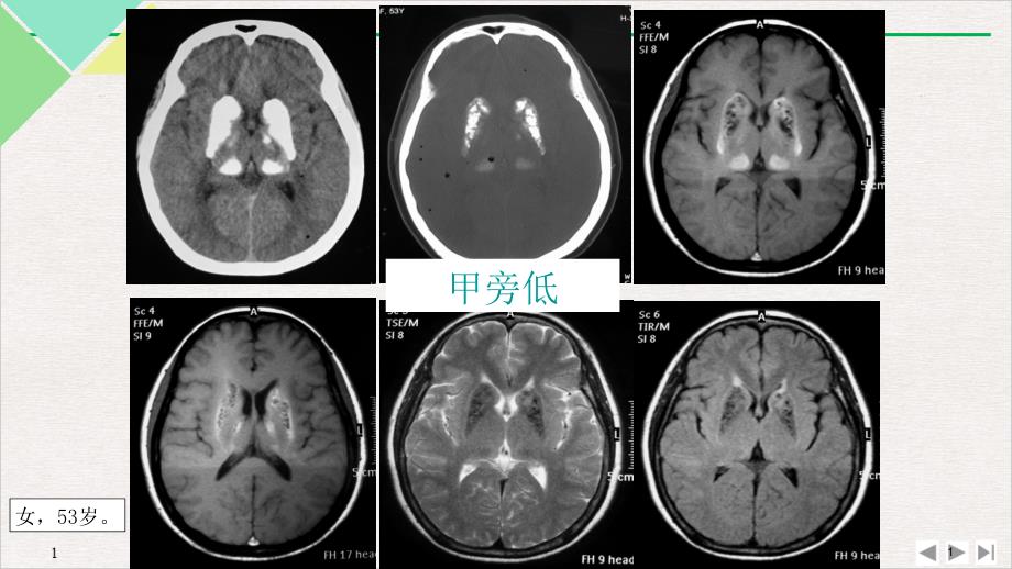 甲状旁腺功能减退症PPT实用版课件_第1页