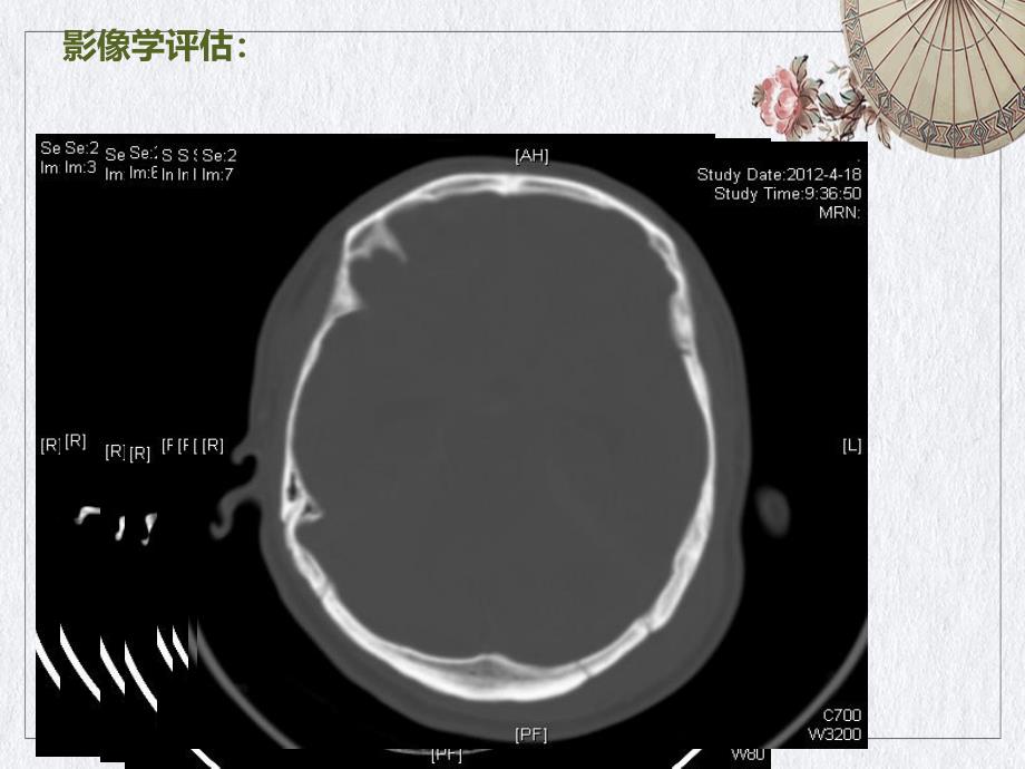 颅内压监测在重型颅脑损伤治疗中的应用ppt课件_第1页