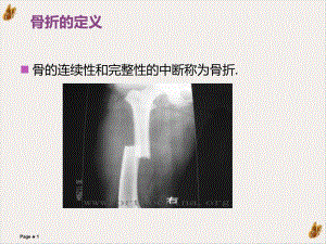 骨折及骨折內(nèi)固定術(shù)后護理實用ppt課件