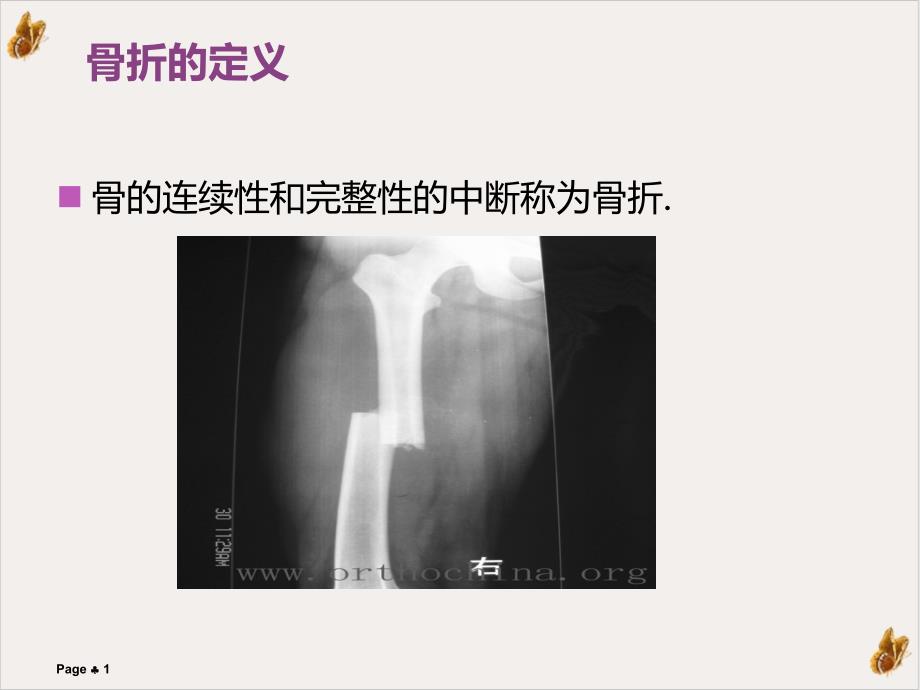 骨折及骨折內(nèi)固定術(shù)后護理實用ppt課件_第1頁