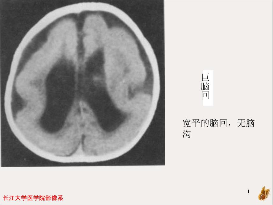 畸形与脑血管课件_第1页