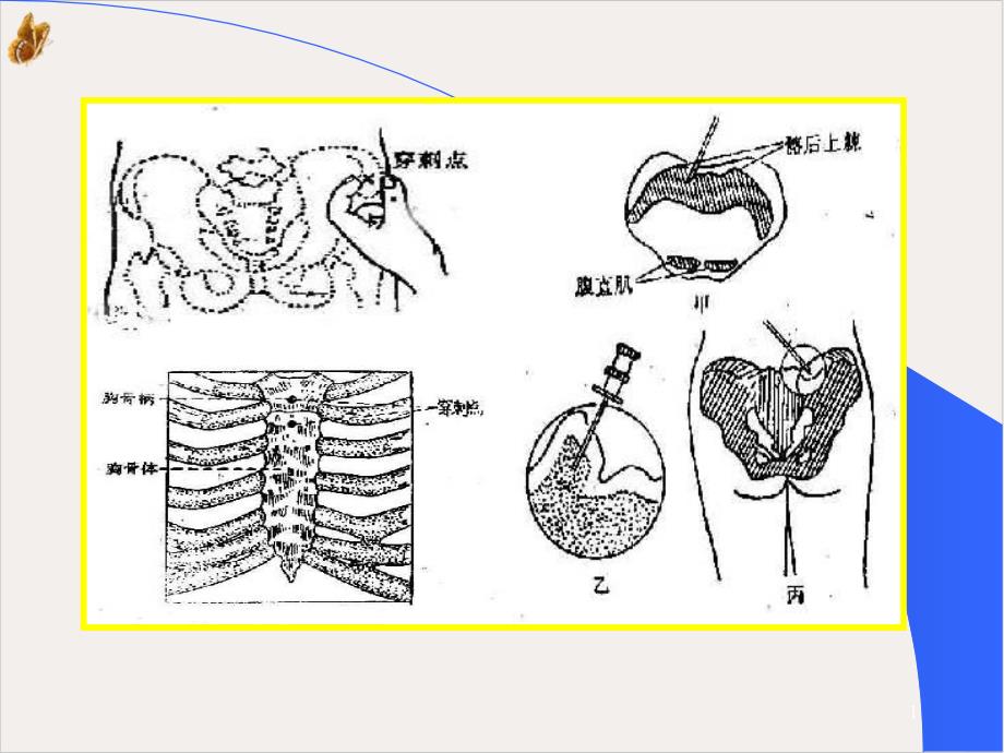 骨髓检查组化免疫分型遗传学培训ppt课件_第1页