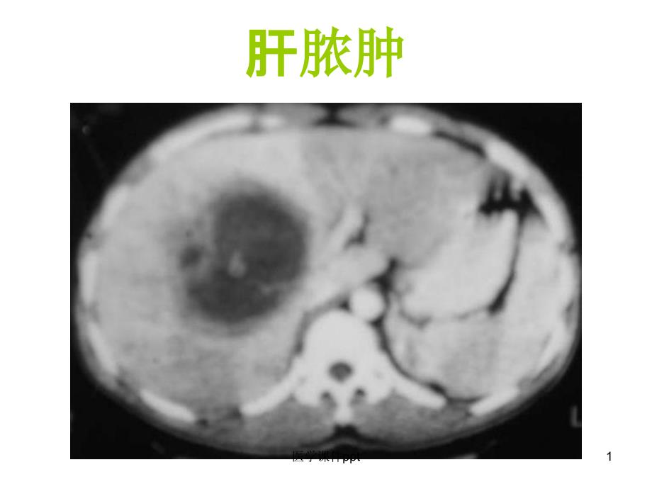 肝脏疾病影像诊断课件_第1页