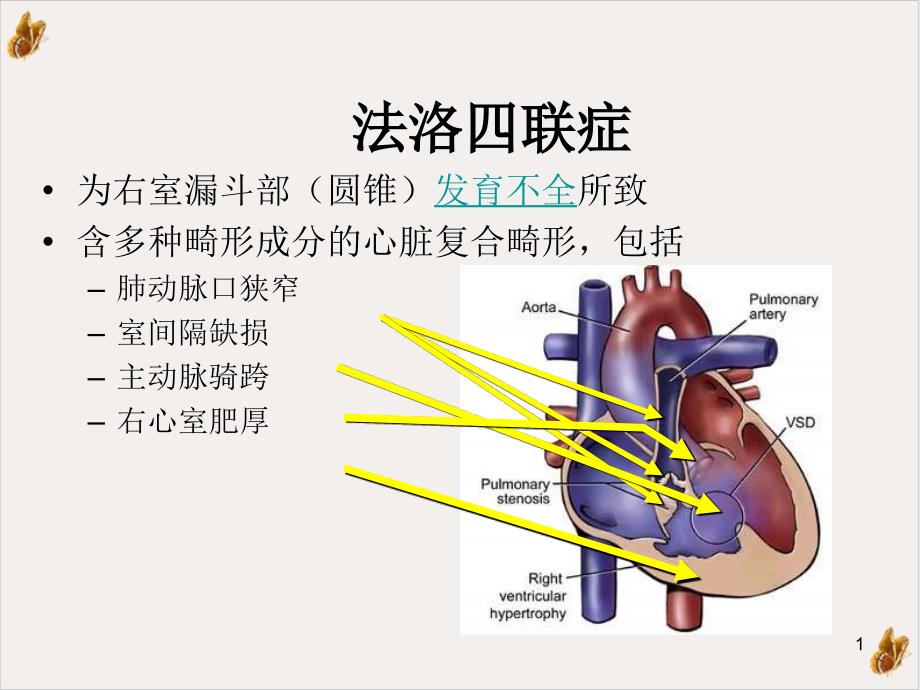 法洛四联症心律失常ppt课件_第1页