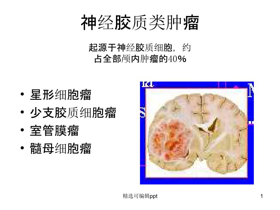 星形细胞瘤CT诊断课件_第1页