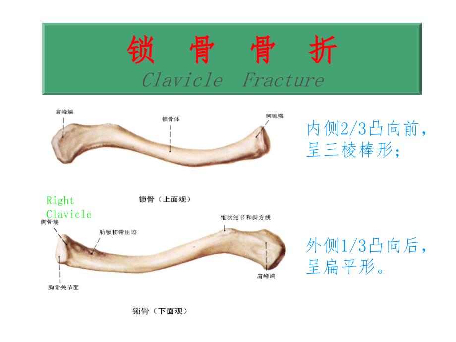 锁骨骨折ppt课件_第1页