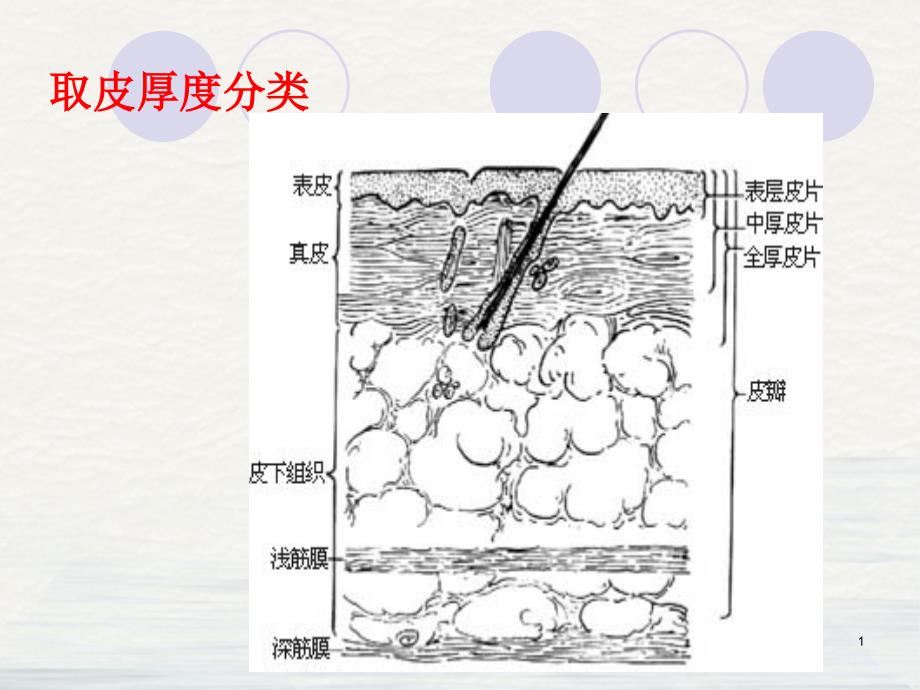 烧伤供皮区创面应用授课课件_第1页