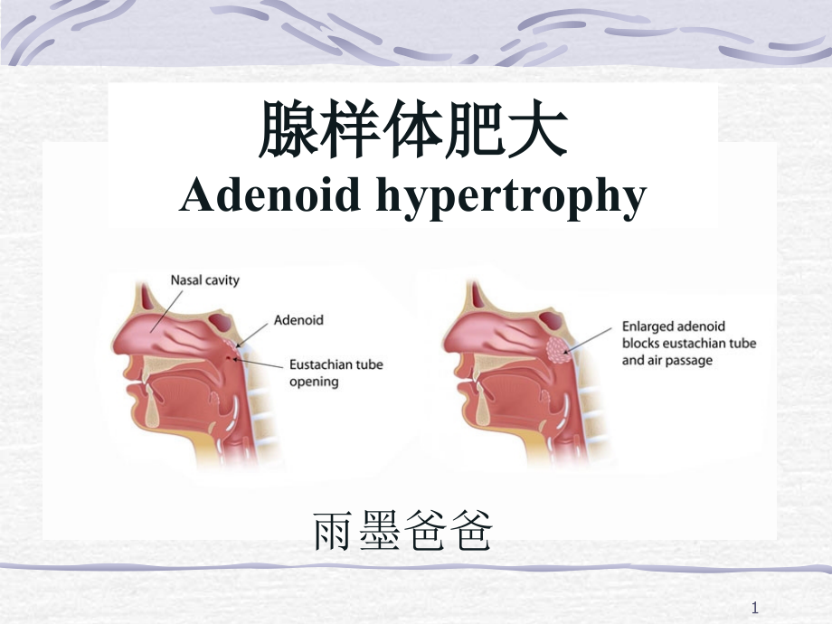 腺样体肥大ppt课件_第1页