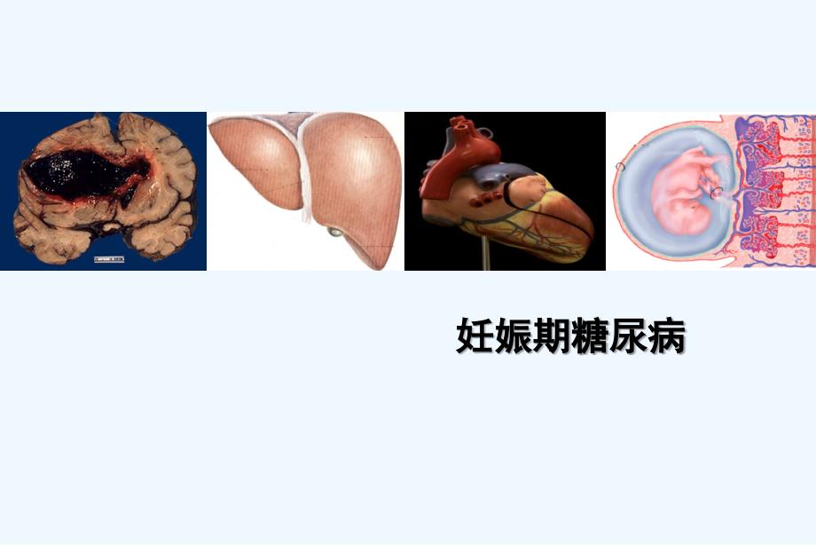 妊娠期糖尿病见习版课件_第1页