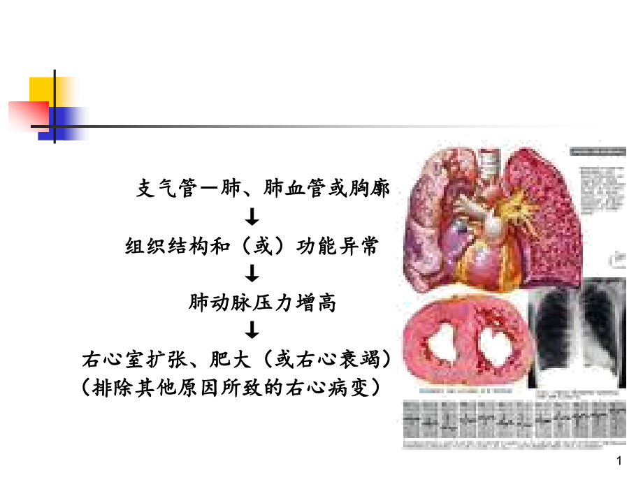 肺源性心脏病护理课件_第1页