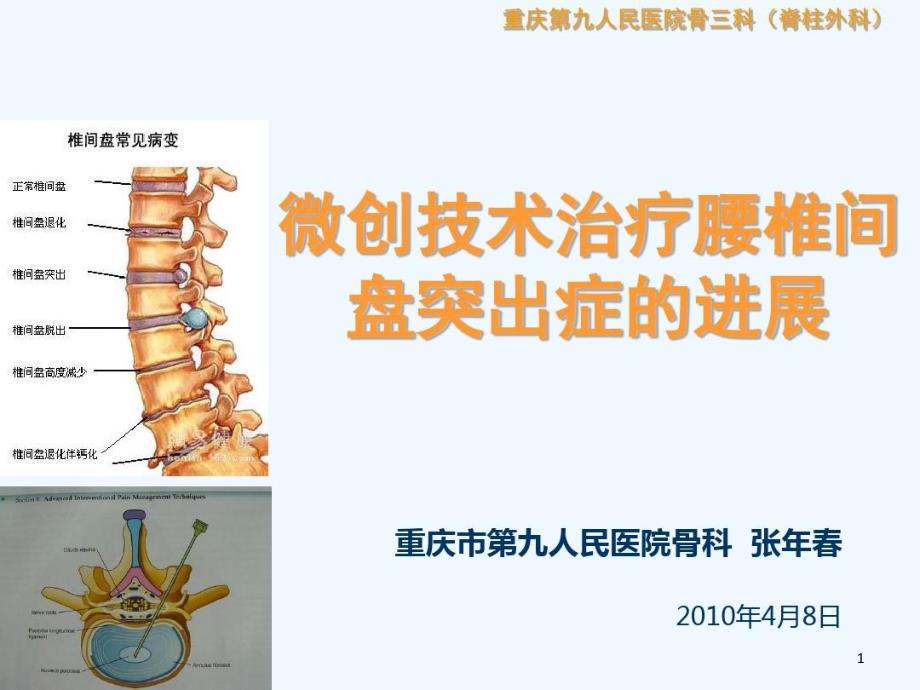 微创治疗腰椎间盘突出症的进展课件_第1页