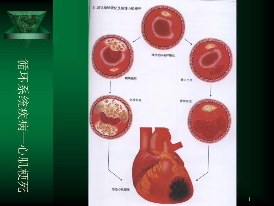 循环系统疾病心肌梗死课件_第1页