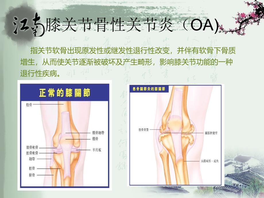 膝痹病中医护理方案课件_第1页