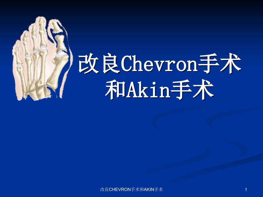 改良CHEVRON手术和AKIN手术ppt课件_第1页