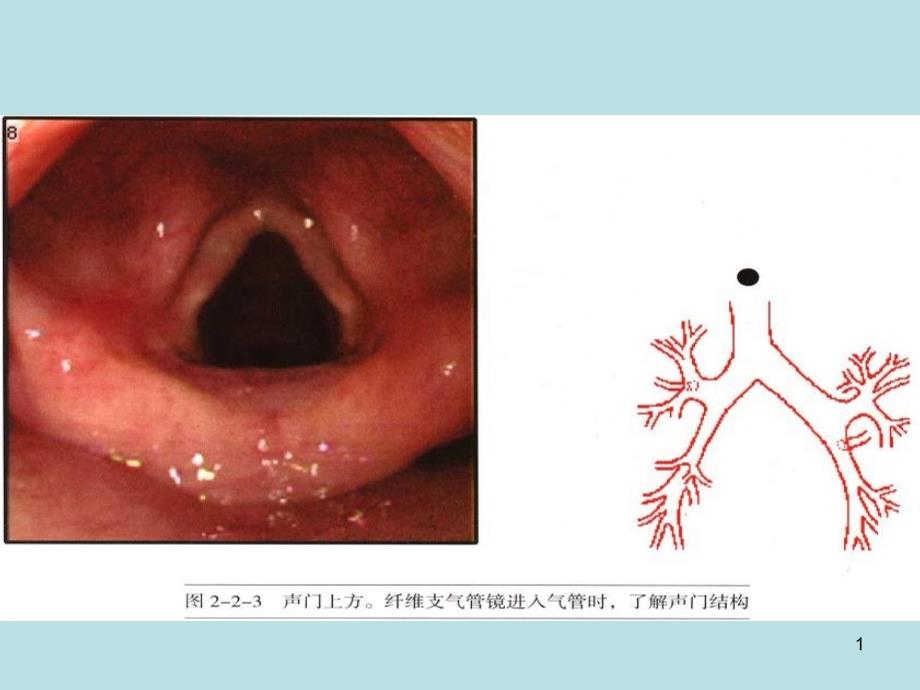 纤支镜图谱最经典纤维支气管镜图谱课件_第1页