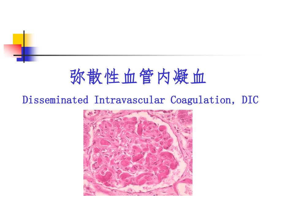 DIC的诊断及治疗课件_第1页