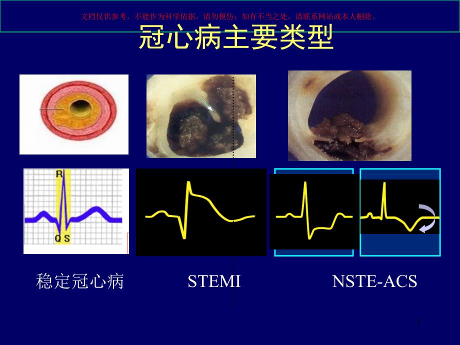 冠心病药物治疗热点ppt课件_第1页