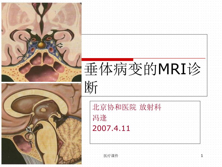 垂体病变的MRI诊断(ppt课件特选)_第1页