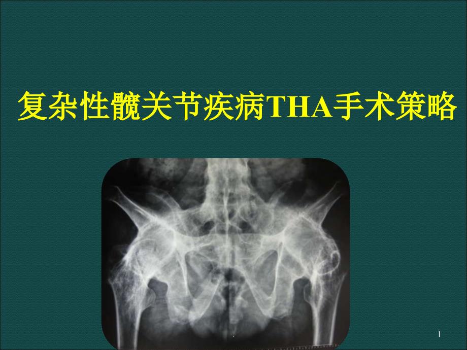 复杂性髋关节THA系列课件_第1页