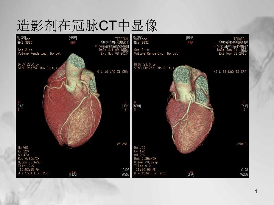 造影剂肾病完美版ppt课件_第1页