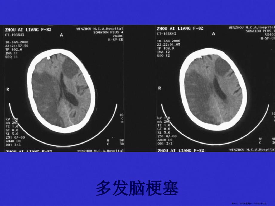 常见疾病CT表现件课件_第1页