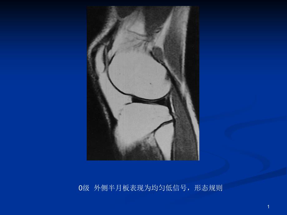 膝关节半月板损伤MRI课件_第1页