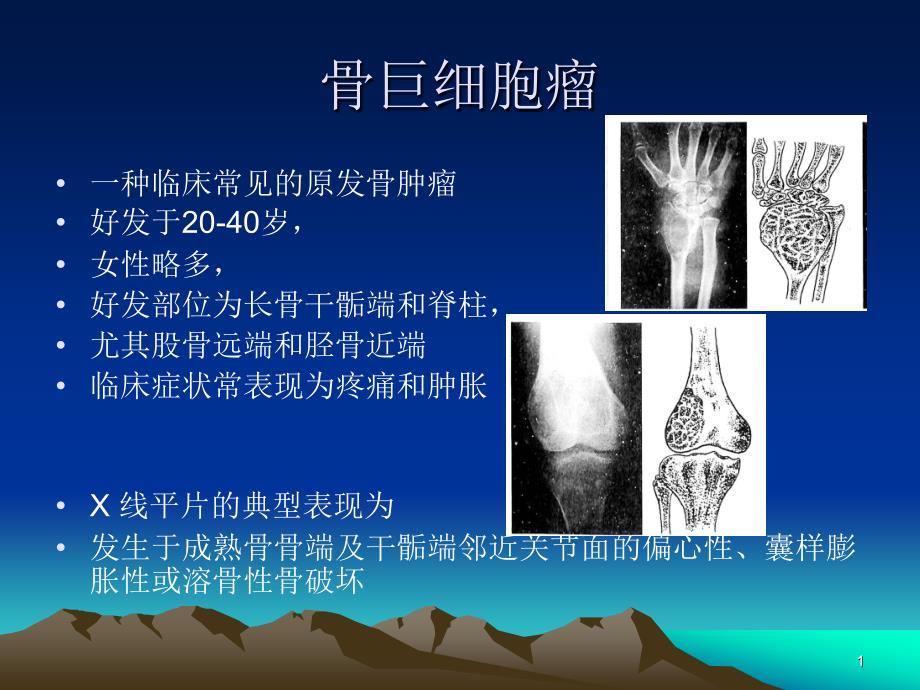 骨巨细胞瘤的治疗ppt课件_第1页