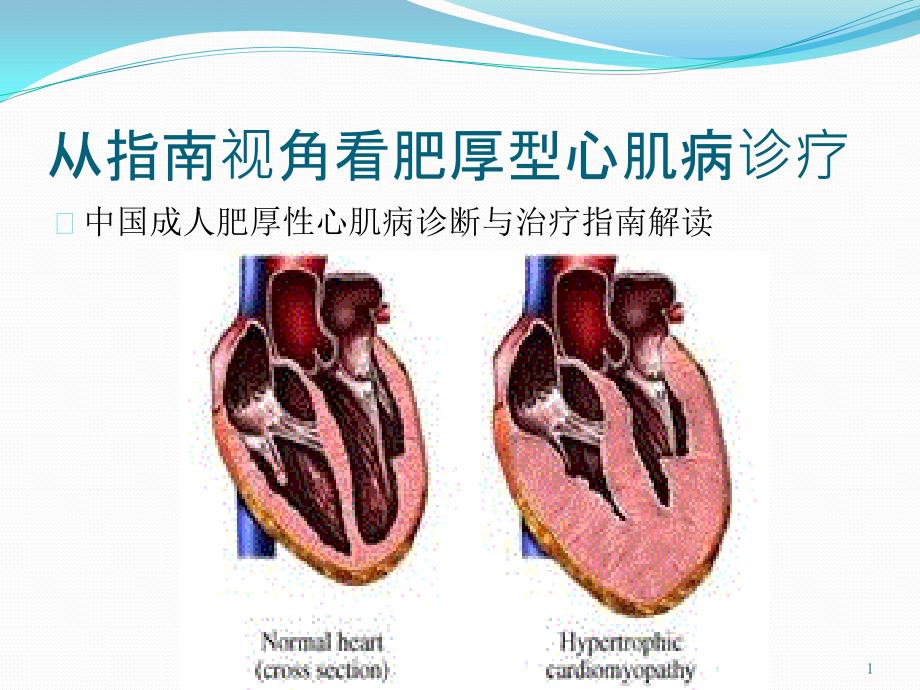 成人肥厚型心肌病诊断与治疗课件_第1页