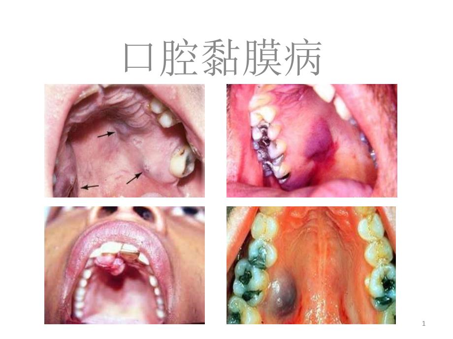 口腔黏膜病课件_第1页