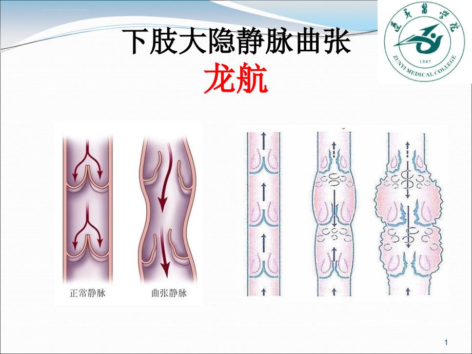 下肢大隐静脉曲张课件_第1页
