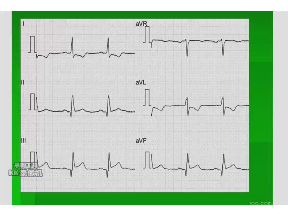 耿老师讲解心梗心电向量心电图课件_第1页