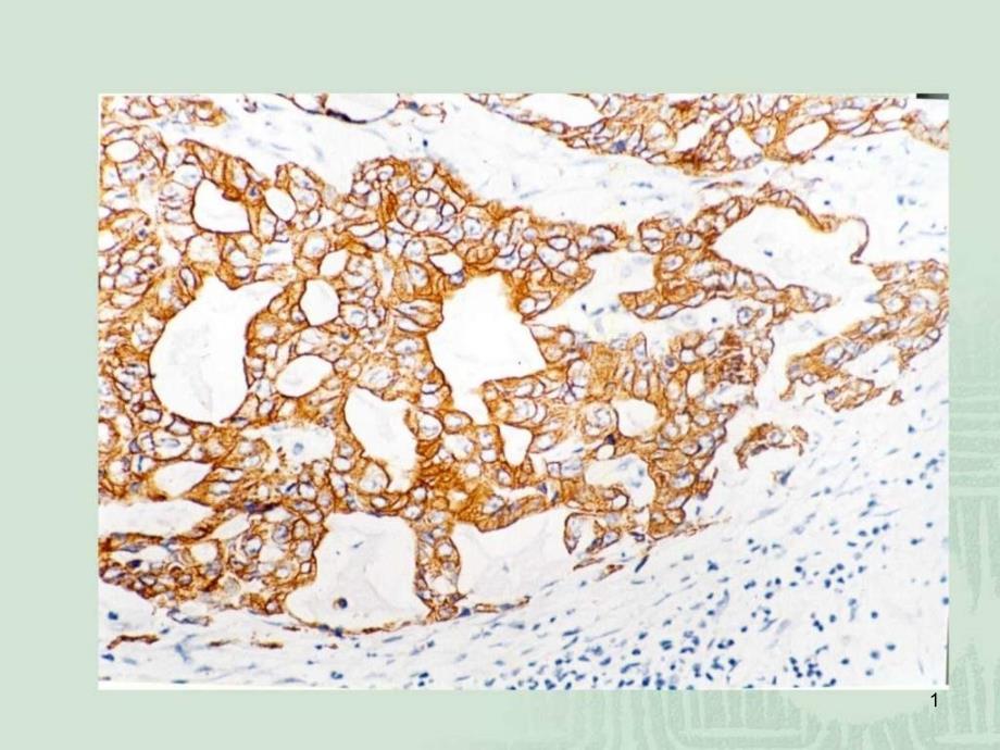 免疫组化结果判断及常见问题的分析课件_第1页