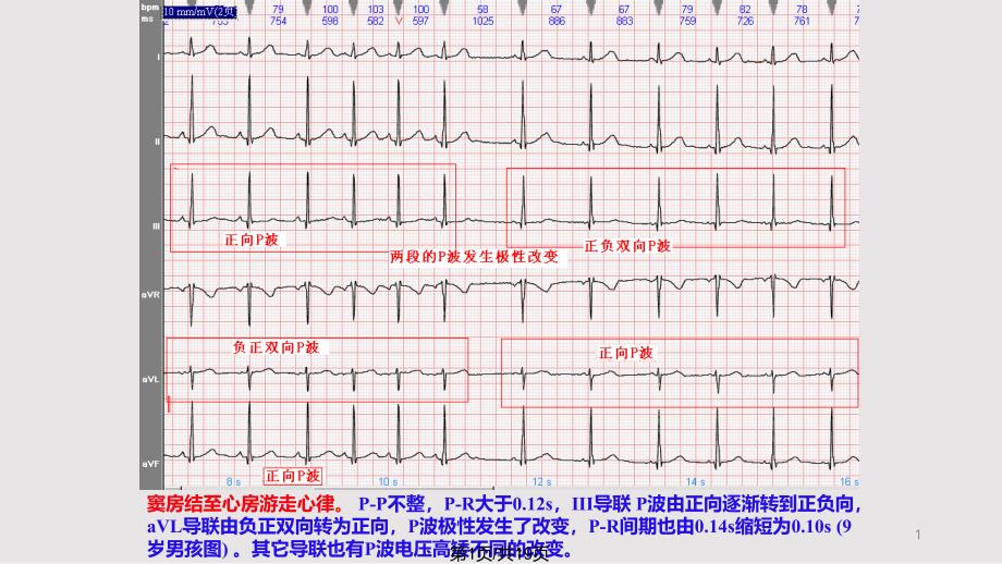 几种心电图鉴别课件_第1页