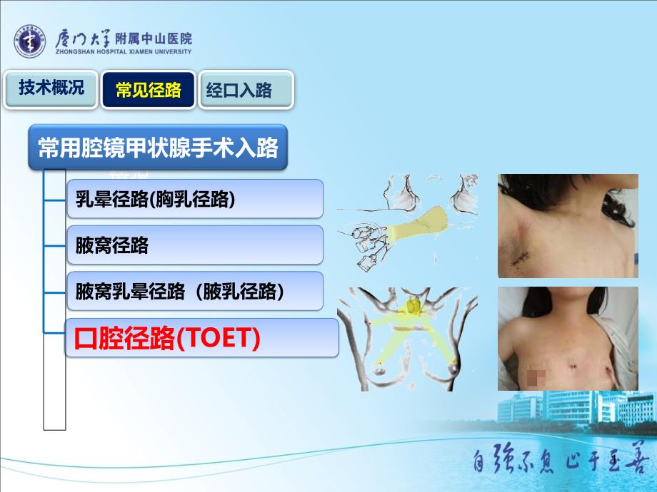 经口入路腔镜甲状腺切除术ppt课件_第1页