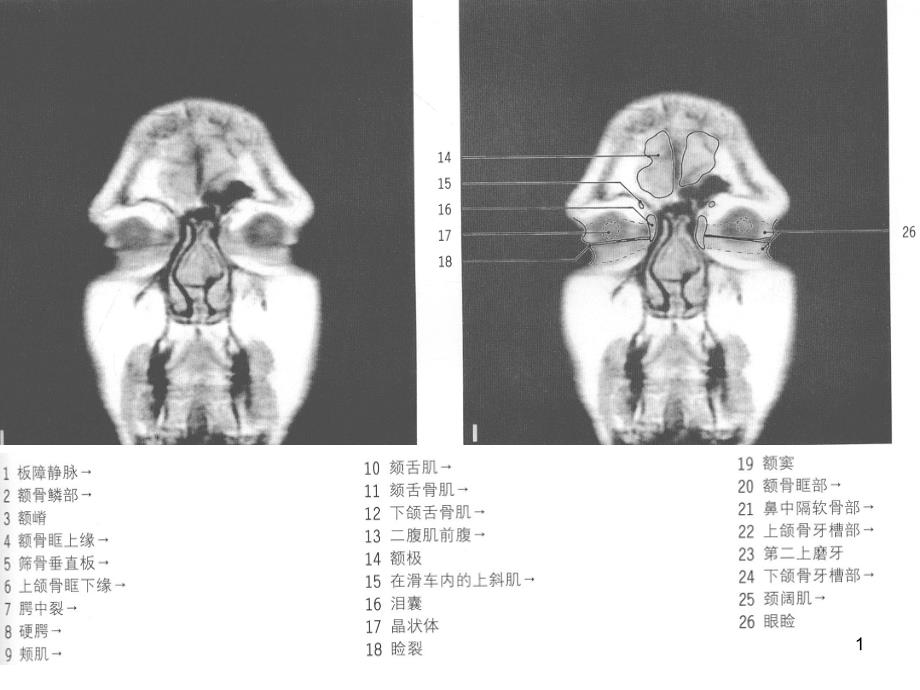 MRI颅脑冠状位解剖图谱课件_第1页