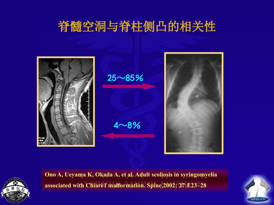 脊髓空洞源性脊柱侧凸的影像学特征及其与侧凸严重程度的相关性课件_第1页